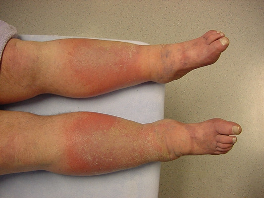 肢端肥大症  (45) 