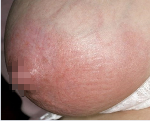 乳房溼疹 (49) 