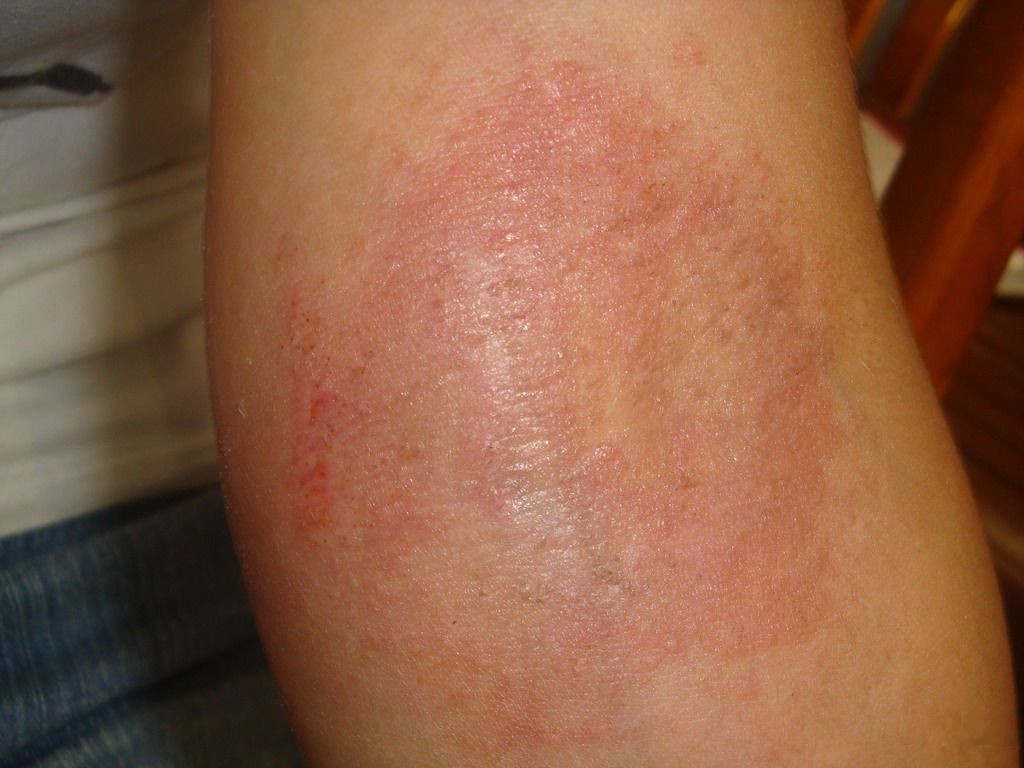 要怎麼治療放射性皮炎