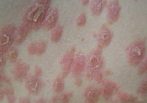 系統性紅斑狼瘡診斷標準 (45) 