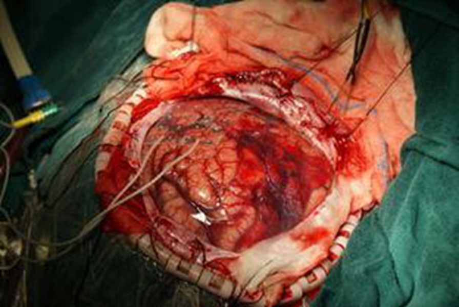 煙霧病左側頭痛