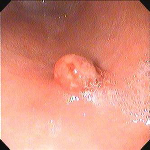 直腸息肉手術後