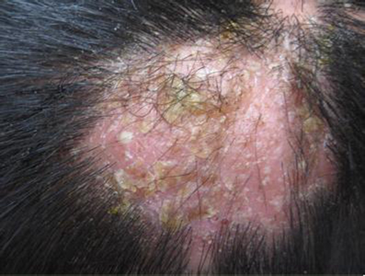 頭皮脂溢性皮炎 (41) 