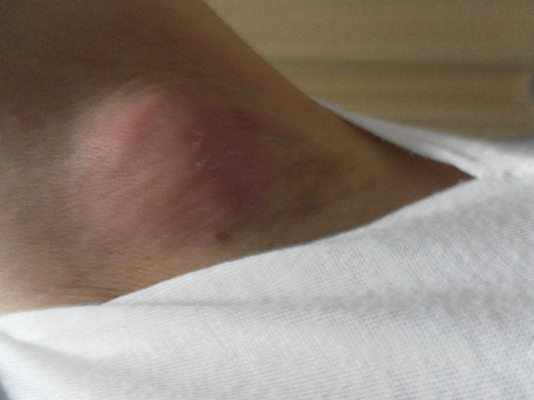 頜下淋巴結腫大