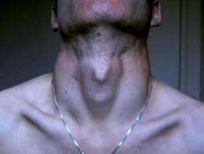 什麼是喉嚨腫瘤