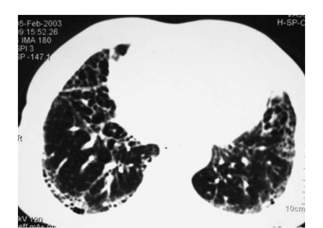 ＿特發性肺間質纖維化