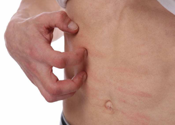 體內有寄生蟲的症狀 (60) 