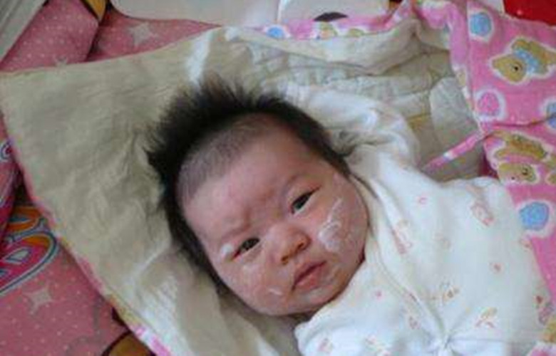 兒童傳染性軟疣治療 