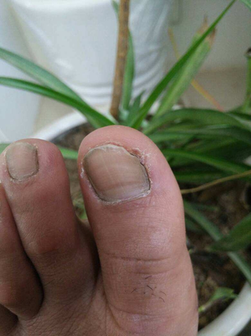 腳大拇指甲周炎