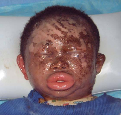 深二度燒傷 (43) 