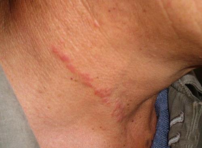 頸部接觸性皮炎