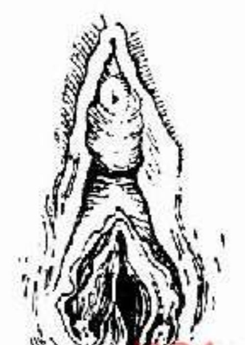 摔傷導致的會陰撕裂的