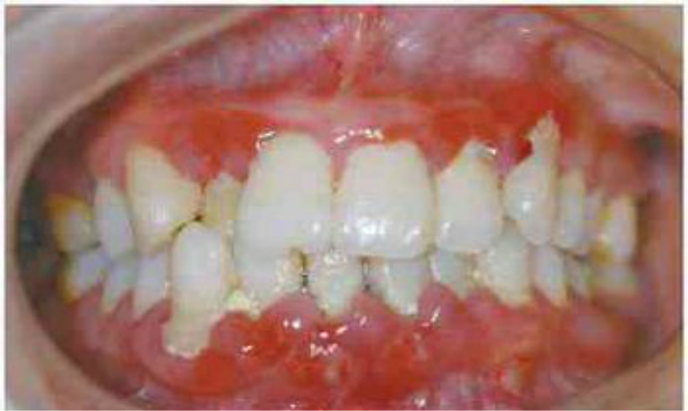 牙齦皮膚念珠菌病