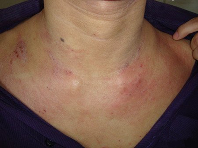鎖骨周圍的放射性皮炎