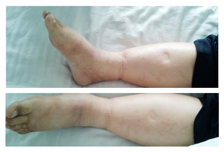 糖尿病腎病腿部水腫