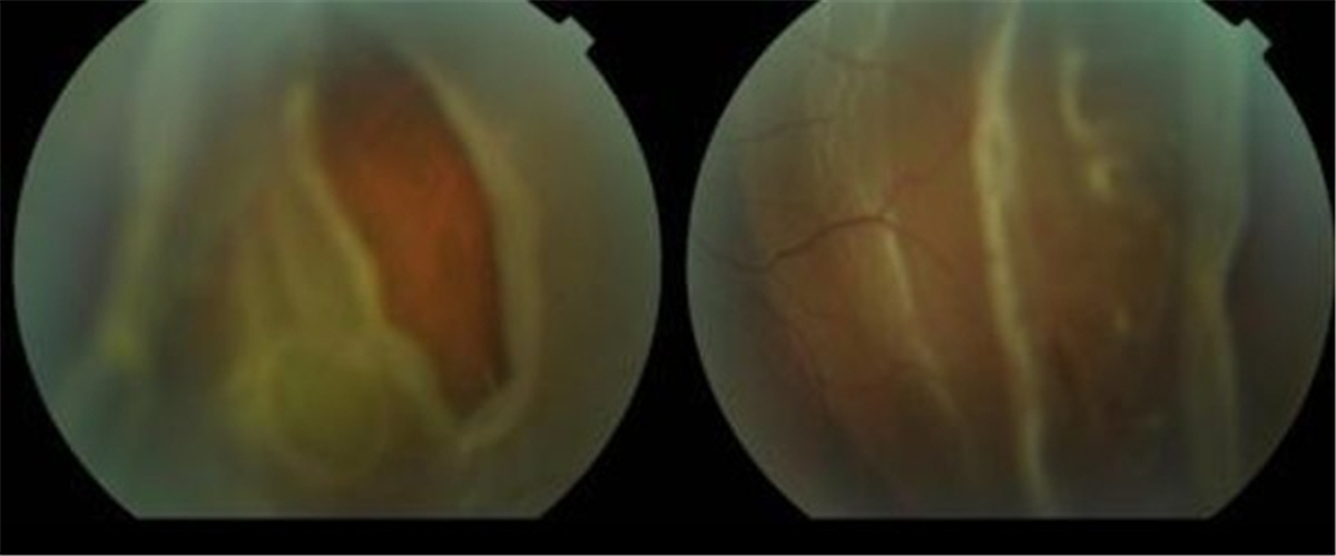 雙眼孔源性視網膜脫落