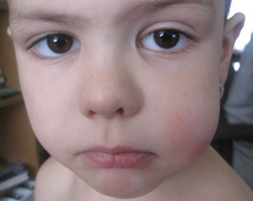 腮腺炎的症狀和