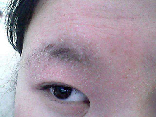 急性皮炎的症狀