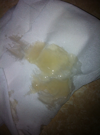 不正常精液液化