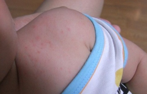 小兒急疹的症狀 (46) 