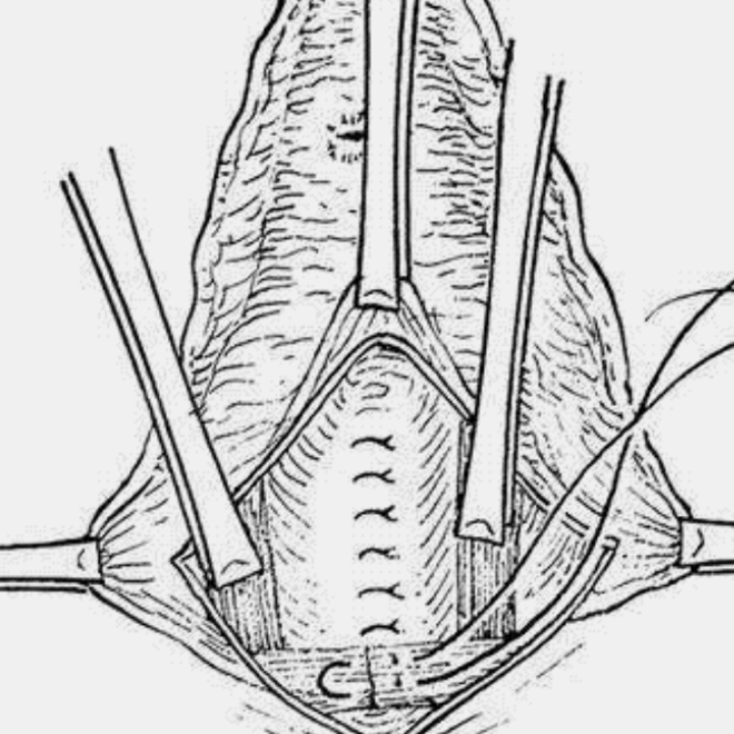 順產後會陰撕裂至肛門
