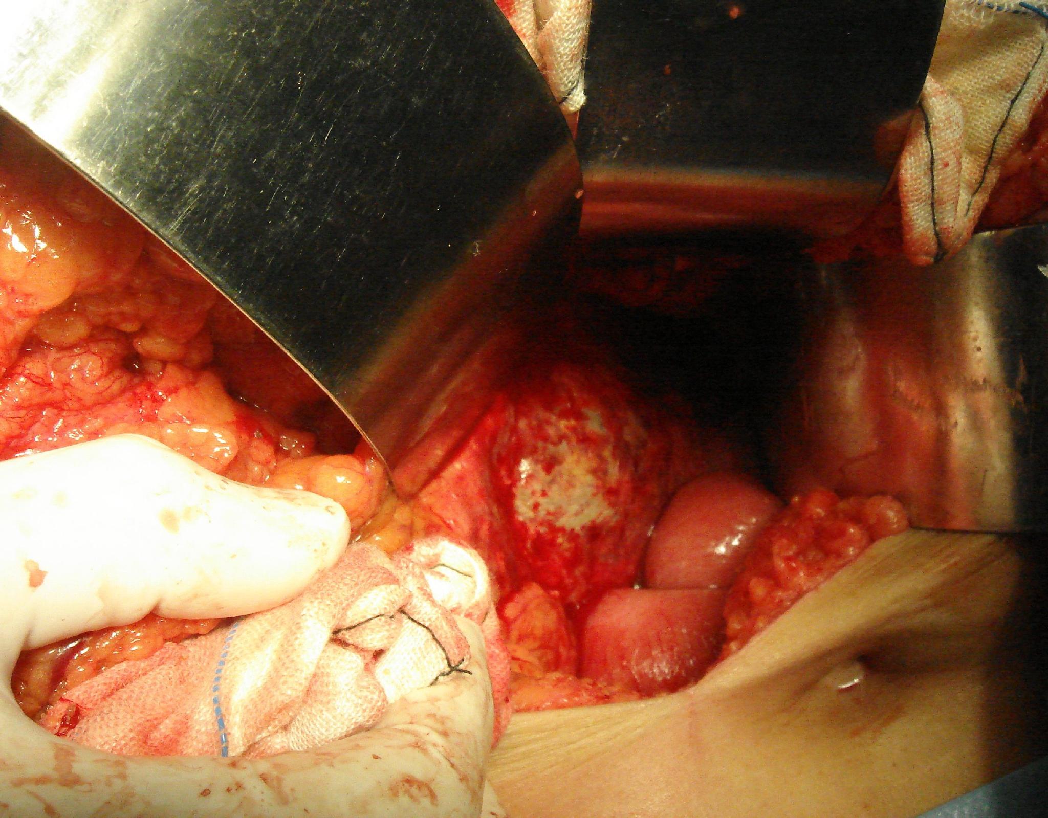 手術治療壞死性急性胰腺炎