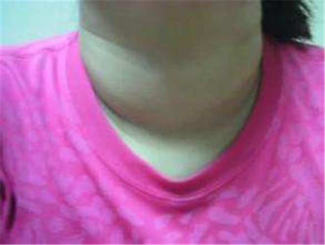 女性甲狀腺結節