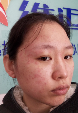 臉上皮膚過敏症狀