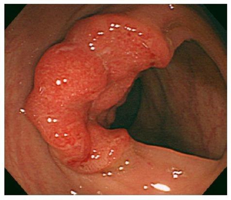 直腸癌晚期症狀 (55) 