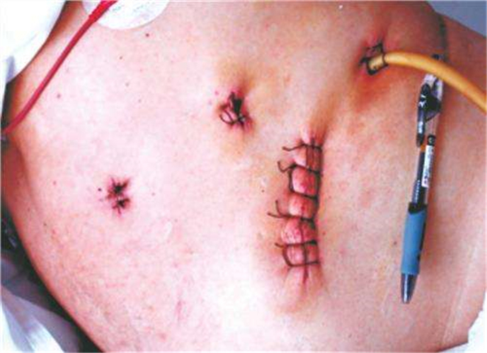 腎囊腫術後創口