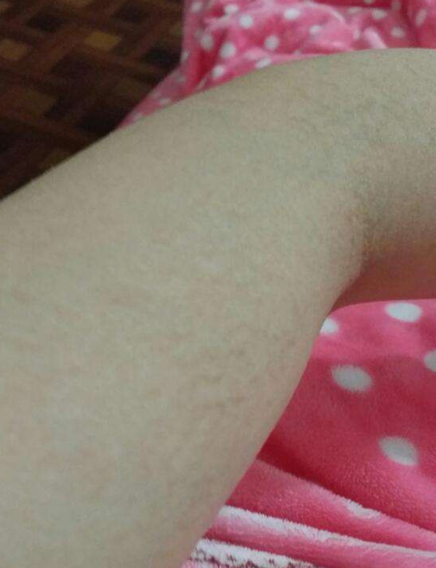 懷孕期妊辰紋大腿