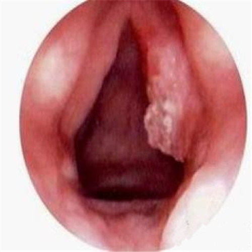 呼吸道感染一側潰爛