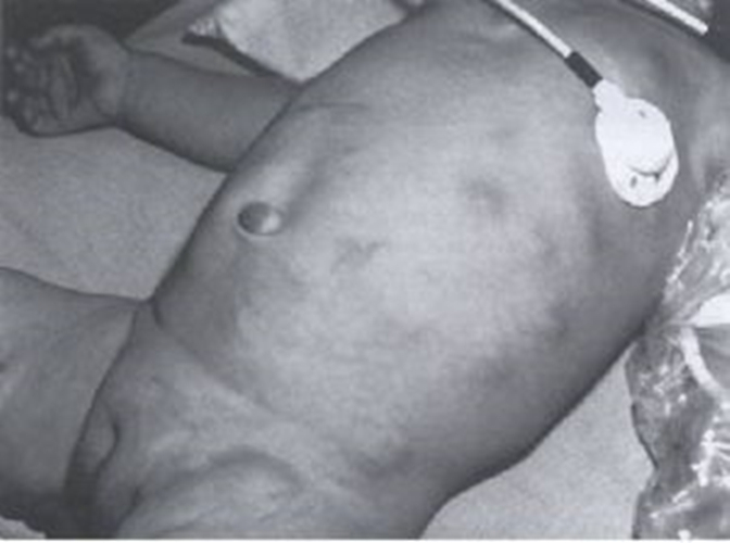 幼兒腎上腺腫瘤