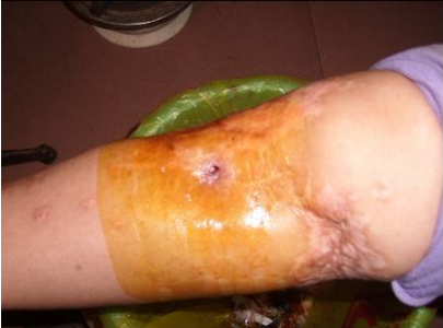 脈管炎早期症狀