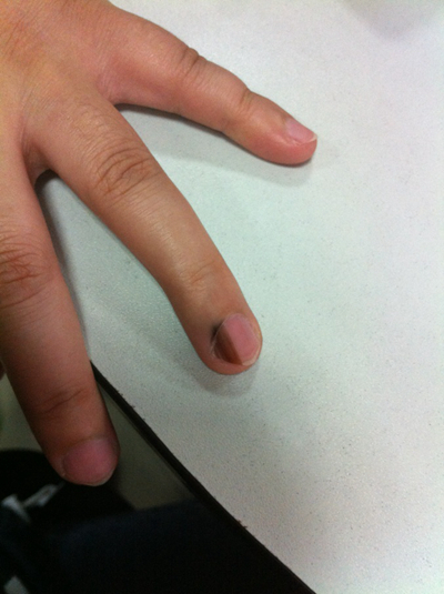 手指甲上有豎紋圖解 (47) 