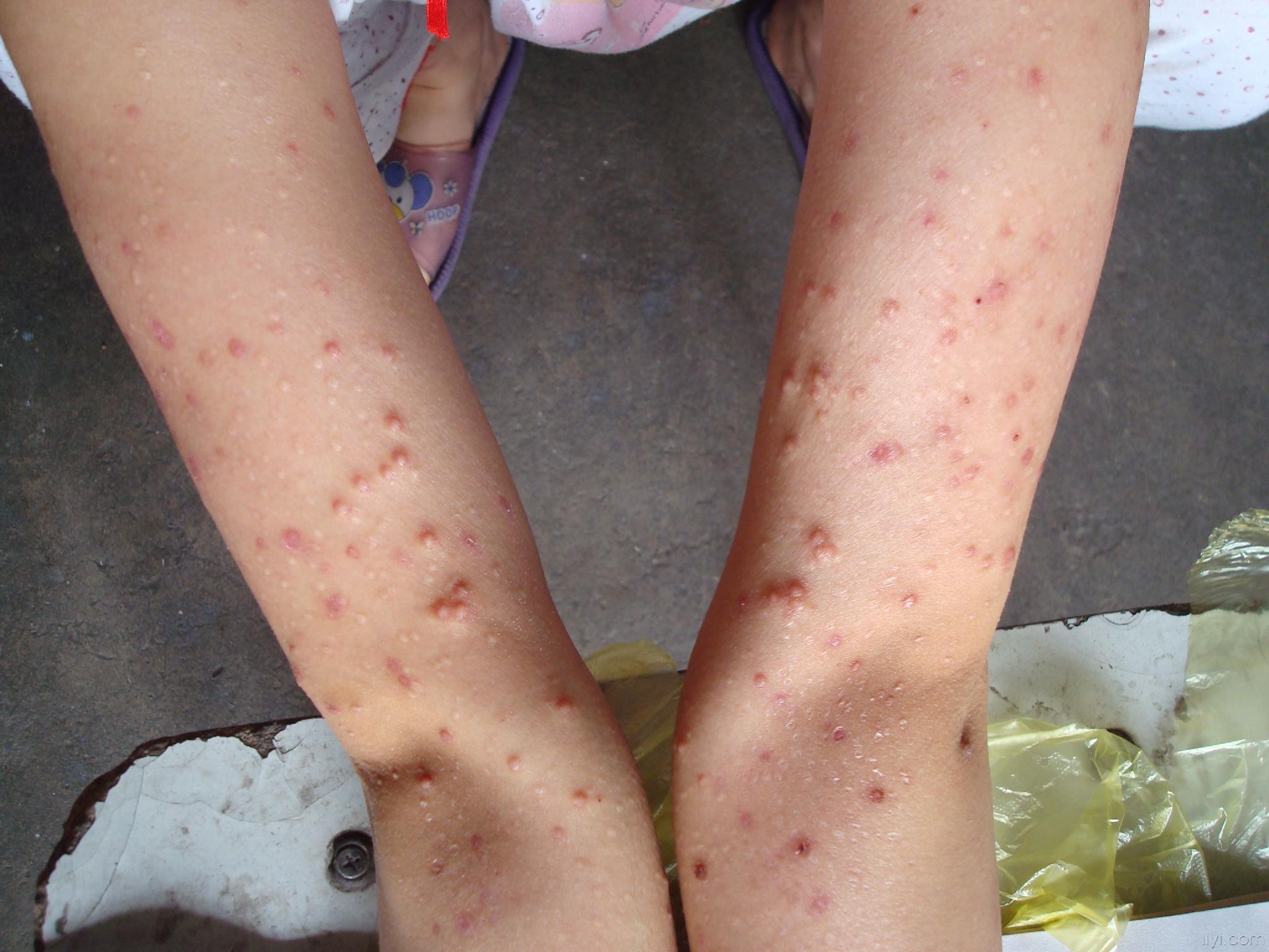 疣狀皮膚結核病早期