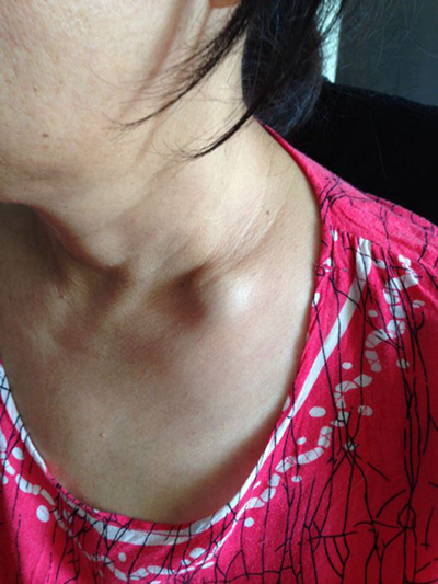 頜下淋巴結腫大