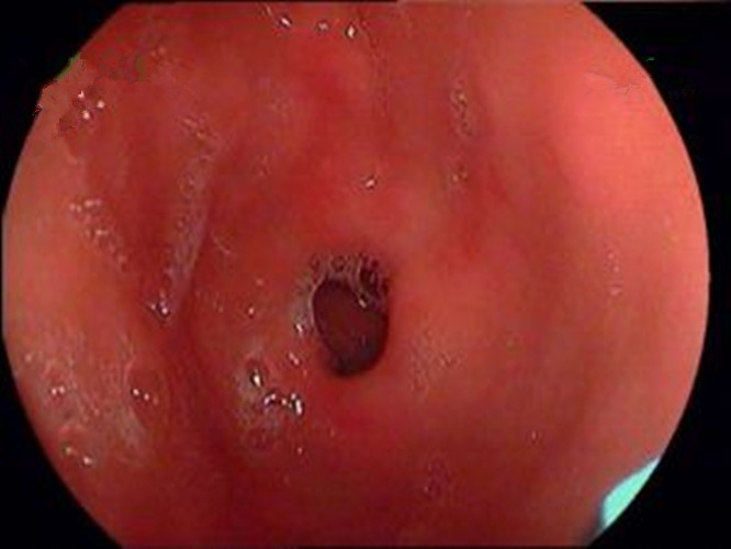 萎縮性的慢性胃炎