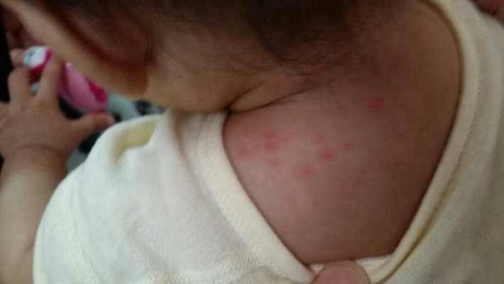 新生兒胎毒的症狀