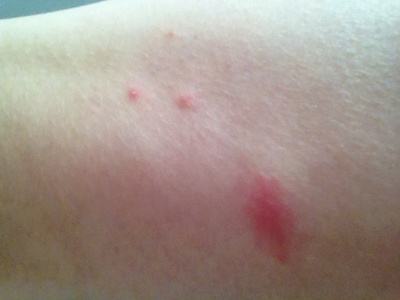 被跳蚤咬的症狀