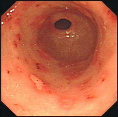胃竇糜爛 (38) 