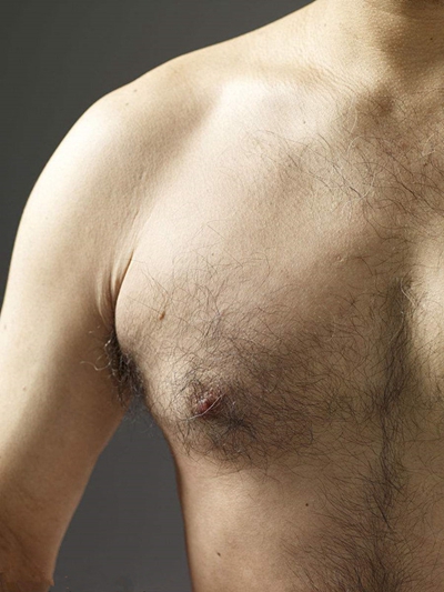 男生胸部突出 (37) 