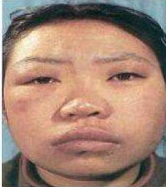 中年人面部水腫甲減