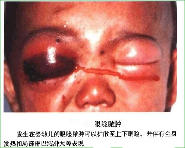 眼瞼腫瘤 瞼 皮膚腫瘤