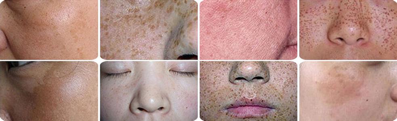 頑固色斑的老年斑