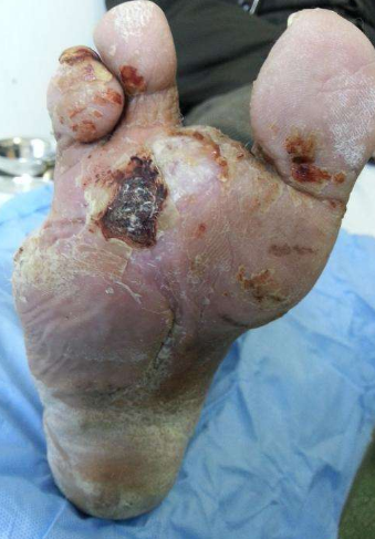 脈管炎早期症狀