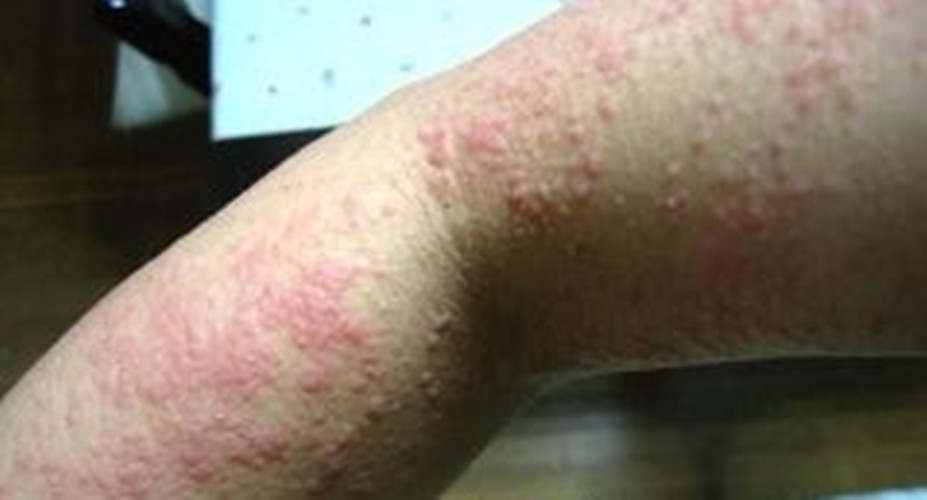 右側上肢放射性皮炎