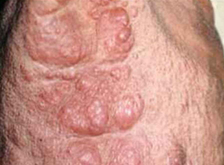 血液淋巴瘤症狀 