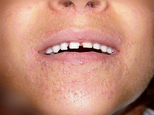 嘴上長皰疹 (41) 