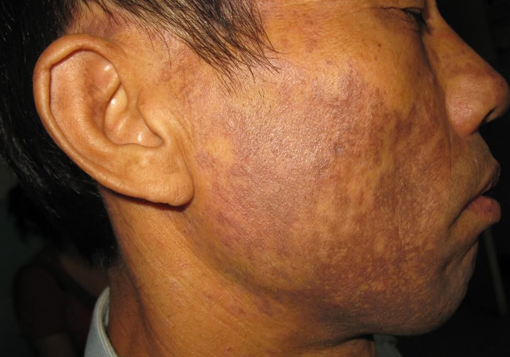 臉部皮膚黑變病